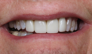 Dental Wellness LA | Dermal Fillers, E4D and Invisalign reg