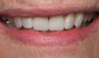 Dental Wellness LA | Emergency Treatment, Extractions and Veneers