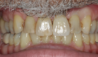 Dental Wellness LA | Dental Lab, All-on-6 and Juvederm reg