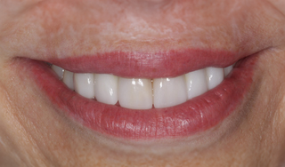 Dental Wellness LA | Dentures, All-on-4 reg and Botox reg