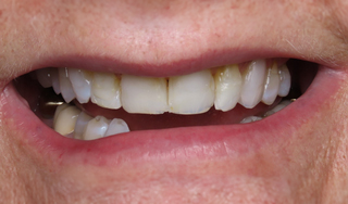 Dental Wellness LA | VELscope reg Cancer Screening, All-on-4 reg and Dental Cleanings