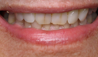 Dental Wellness LA | Veneers, Dermal Fillers and Sleep Apnea