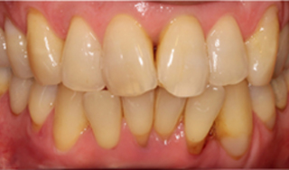 Dental Wellness LA | Periodontal Treatment, ZOOM Whitening and Implant Restorations
