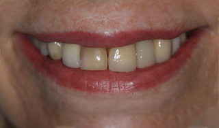 Dental Wellness LA | Sedation Dentistry, All-on-6 and Sleep Apnea